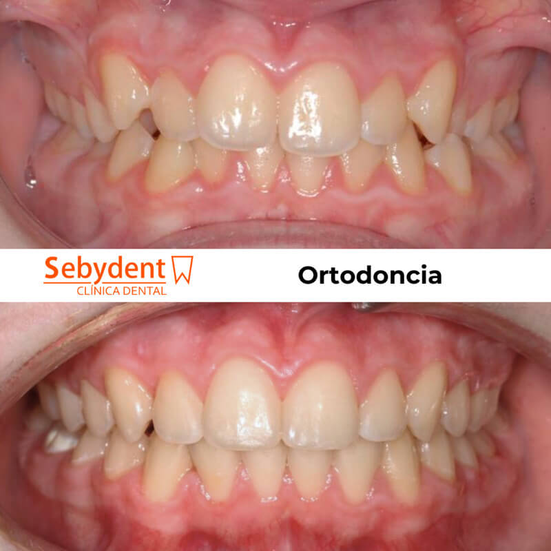 imagenes resultados ortodoncia clinica dental talavera de la reina