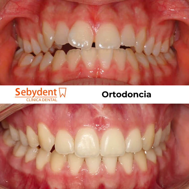 antes y despues ortodoncia talavera