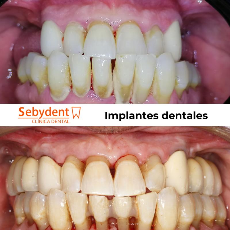 implantes dentales antes y depues