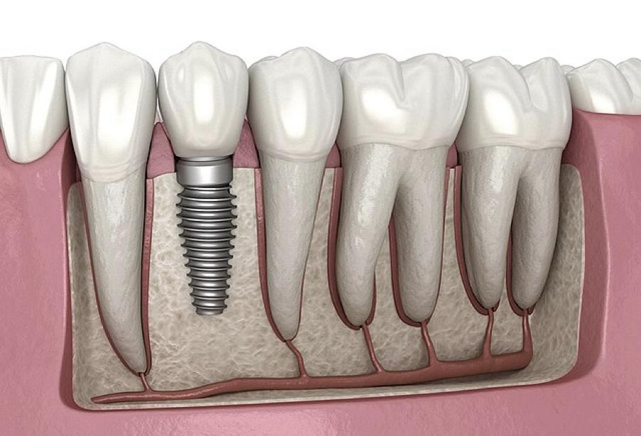 regeneracion osea para implantes dentales
