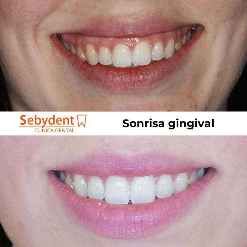 tratamientos de la sonrisa gingival