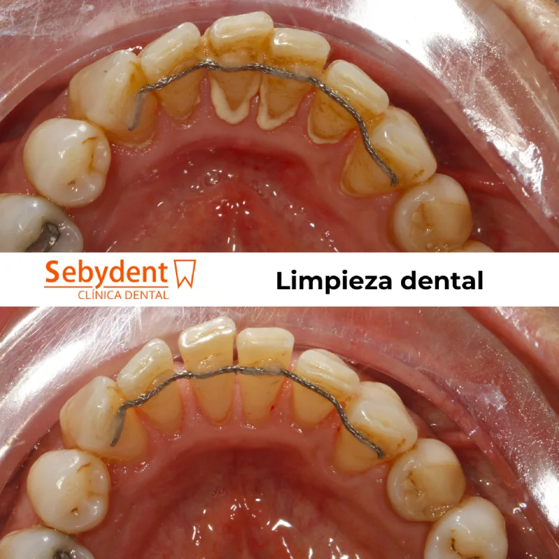 resultados de una limpieza dental dentistas sebydent