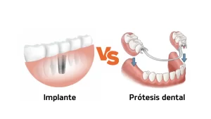 que es mejor implante dental o protesis dental