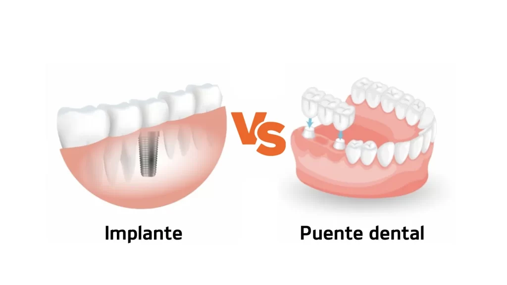 implante dental o puente dental diferencias