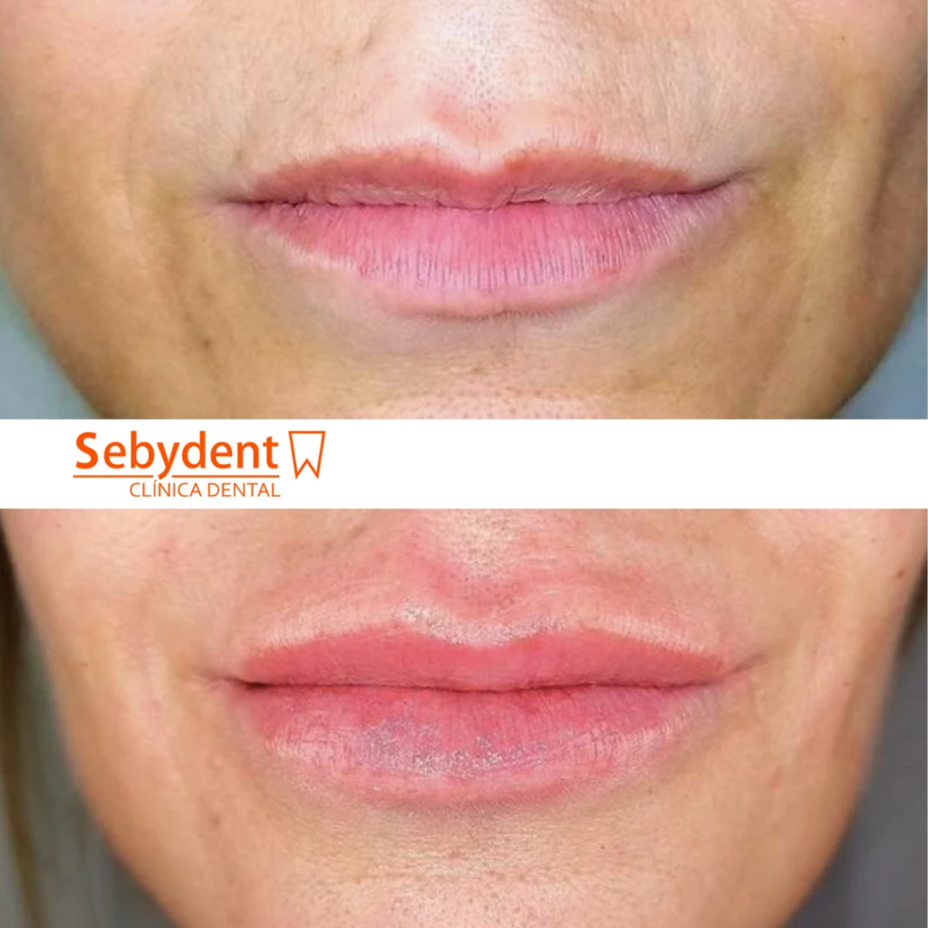 antes despues acido hialuronico labios