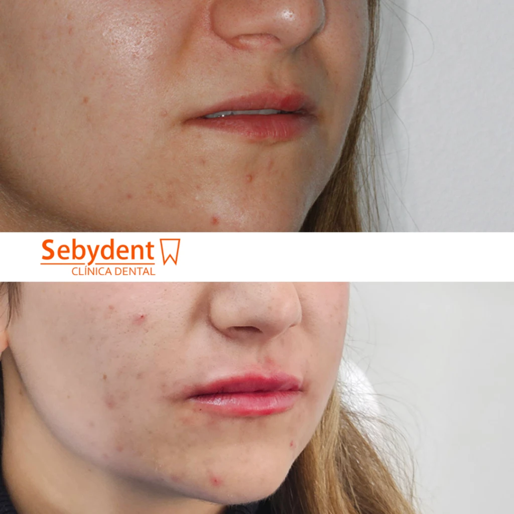 resultados acido hialuronico labios talavera de la reina